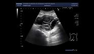 Ultrasound Video showing Multiseptic Ovarian Cyst.