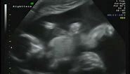 20 Week Ultrasound Identical Twins (Boys)