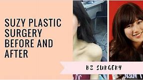 Suzy Plastic Surgery Before and After