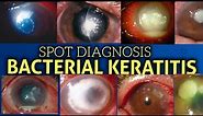 Bacterial keratitis || clinical features||