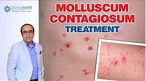 Molluscum Contagiosum Treatment | Dr Rohit Batra