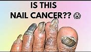 IS THIS NAIL CANCER?? symptoms | HOW TO IDENTIFY NAIL CANCER | SUBUNGUAL MELANOMA | MELANOMA