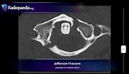 Jefferson fracture - radiology video tutorial (x-ray, CT)