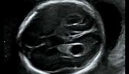 Fetal Medicine Foundation - Choroid plexus cyst