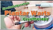 How to Treat Plantar Warts with Electrofulguration and Cryotherapy | Viral Warts | Electric Cautery