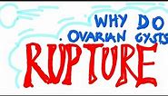Why Do Ovarian Cysts RUPTURE? What You Should Know | Cause #1