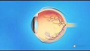 What causes a macular hole?
