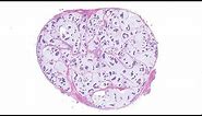Mucinous carcinoma of skin - BEST EXAMPLE EVER! (AIP France 2021 - Bonus case) dermpath pathology