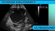 Ovarian Malignancy(Cancer) on ultrasound Scan.