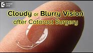 How long is your vision blurry or cloudy after cataract surgery? - Dr. Sriram Ramalingam