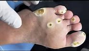 Pedicure- Plantar warts | Removing dead skin step by step for the treatment of warts / part 52