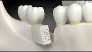 What is a dental bone graft?