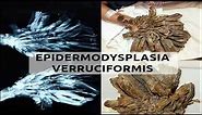 What is Epidermodysplasia Verruciformis || H - T