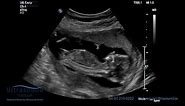 Scan of the Week: 15 Weeks Pregnant (The Advanced Early Ultrasound)
