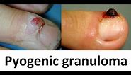 Pyogenic Granuloma - Surgical Treatment
