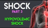 Hypovolemic Shock | Shock (Part 3)