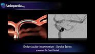 Stroke: Endovascular management of ischaemic stroke - radiology video tutorial