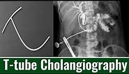 T-tube Cholangiography| When is T-tube Cholangiography Performed? Cholangiogram: Purpose & Procedure