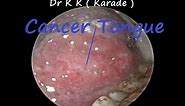 Cancer Tongue ( Squamous Cell Carcinoma ) , How it look like ?
