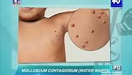 UNTV Life: What causes water warts in adults and kids?