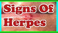 Signs Of herpes : Symptoms Of herpes
