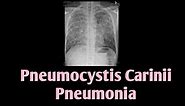 Pneumocystis Carinii Pneumonia || PCP || Pneumocystis Jirovecii