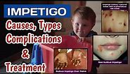 Impetigo Skin Infection Causes, Types, Symptoms, Treatment, Complications & Predisposing lesions
