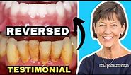 Gum Recession and Bone Loss Reversed (Testimonial)