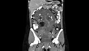 Ovarian Teratoma Coronal CT