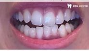 Aligners Journey | Invisible Braces Before And After