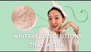 WHITEHEADS (aka those annoying tiny white bumps) - Main Causes & How To Get Rid of Them Long Term