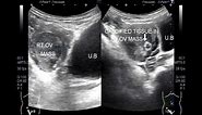 Ultrasound Video showing Ovarian Mass with calcified tissue.