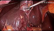 Gallbladder Stone Surgery