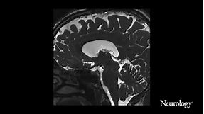 Choroid plexus hyperplasia: A possible cause of hydrocephalus in adults