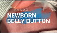 Newborn belly button signs of infection, What's normal healing, Should I call doctor, What to expect