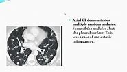 lung anatomy and approach to multiple lung nodules