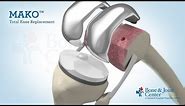 Full Knee Replacement | Mako Robotic Arm Assisted Surgery Technology