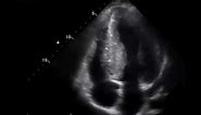 Systolic anterior motion (SAM) of the mitral valve in HCMP.