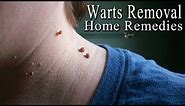 Warts - 5 Simple Home Remedies to Get Rid of Facial Warts Naturally |
