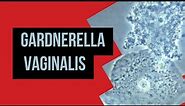Gardnerella Vaginalis/Bacterial Vaginosis /Amsel Criteria / Nugent Score /Microbiology