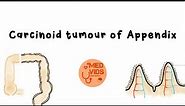 Carcinoid tumour of appendix | Argentaffinoma | Surgery - Pathology | Med vids made simple