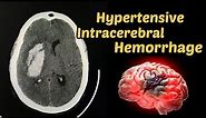 Hypertensive Intracerebral Hemorrhage ICH : Stroke CT Scan Brain | Radiology