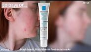 30 DAYS OF La Roche-Posay Effaclar Duo for Blemishes, Blackheads & Post-Acne Marks |One Month Review