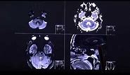Chordoma - aggressively growing tumor in CT and MRI sequence english