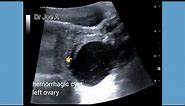 hemorrhagic cyst ovary, Ultrasound and color Doppler video