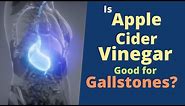 Apple Cider Vinegar for Gallstones- Can Apple Cider Vinegar Dissolve Gallstones?