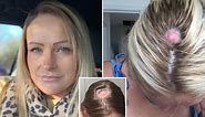 Mum-of-three left with gaping ‘crater’ on scalp after cyst turns out to be skin cancer
