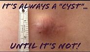 Skin lump/bump? It's NOT always "just a cyst/lipoma"! Misdiagnosed Skin Cancer/Sarcoma Mimic Cyst