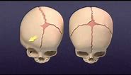 Craniosynostosis - Mayo Clinic