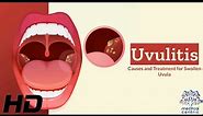 Uvulitis Explained: What's Causing Your Swollen Uvula?